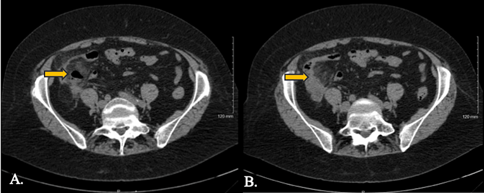 A Rare Cause Of Right Lower Quadrant Abdominal Pain Uncomplicated