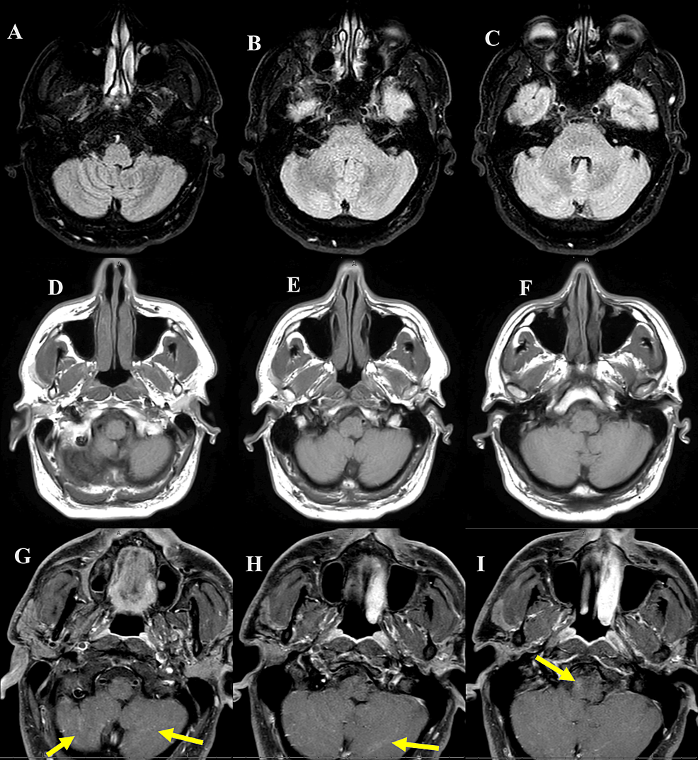 Cureus  Concurrent Longitudinal Extensive Transverse Myelitis and  Leptomeningitis in West Nile Virus: A Report of a Rare Case