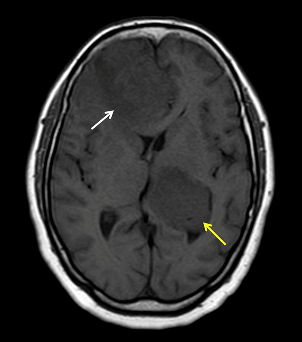 An Uncommon Coexistence of Dural and Intraventricular Meningiomas