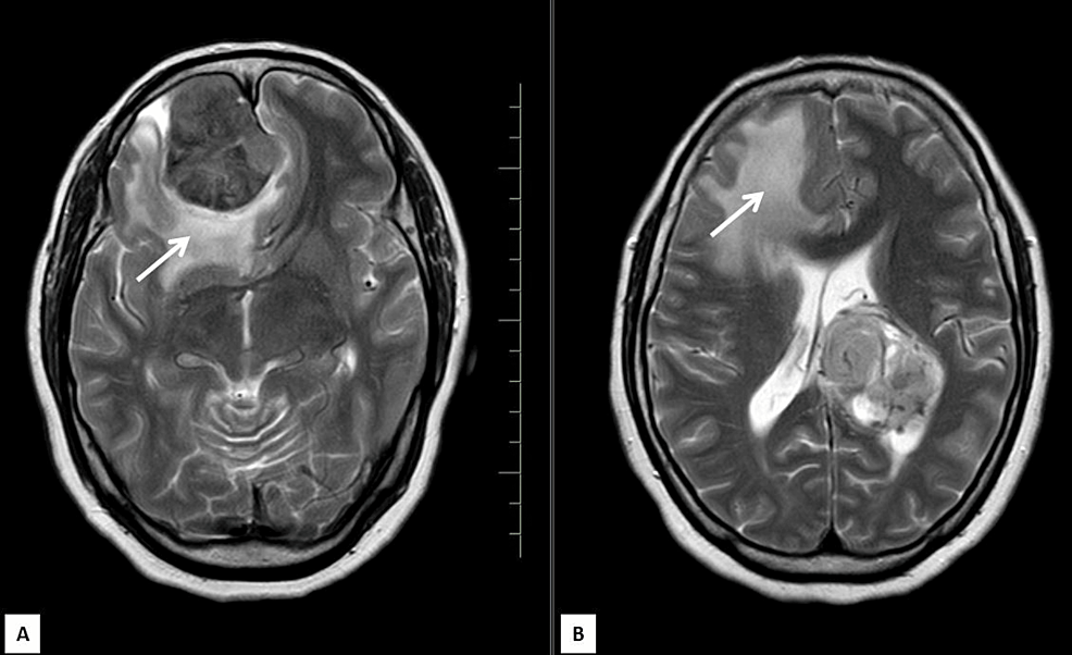 Cureus | An Uncommon Coexistence Of Dural And Intraventricular Meningiomas