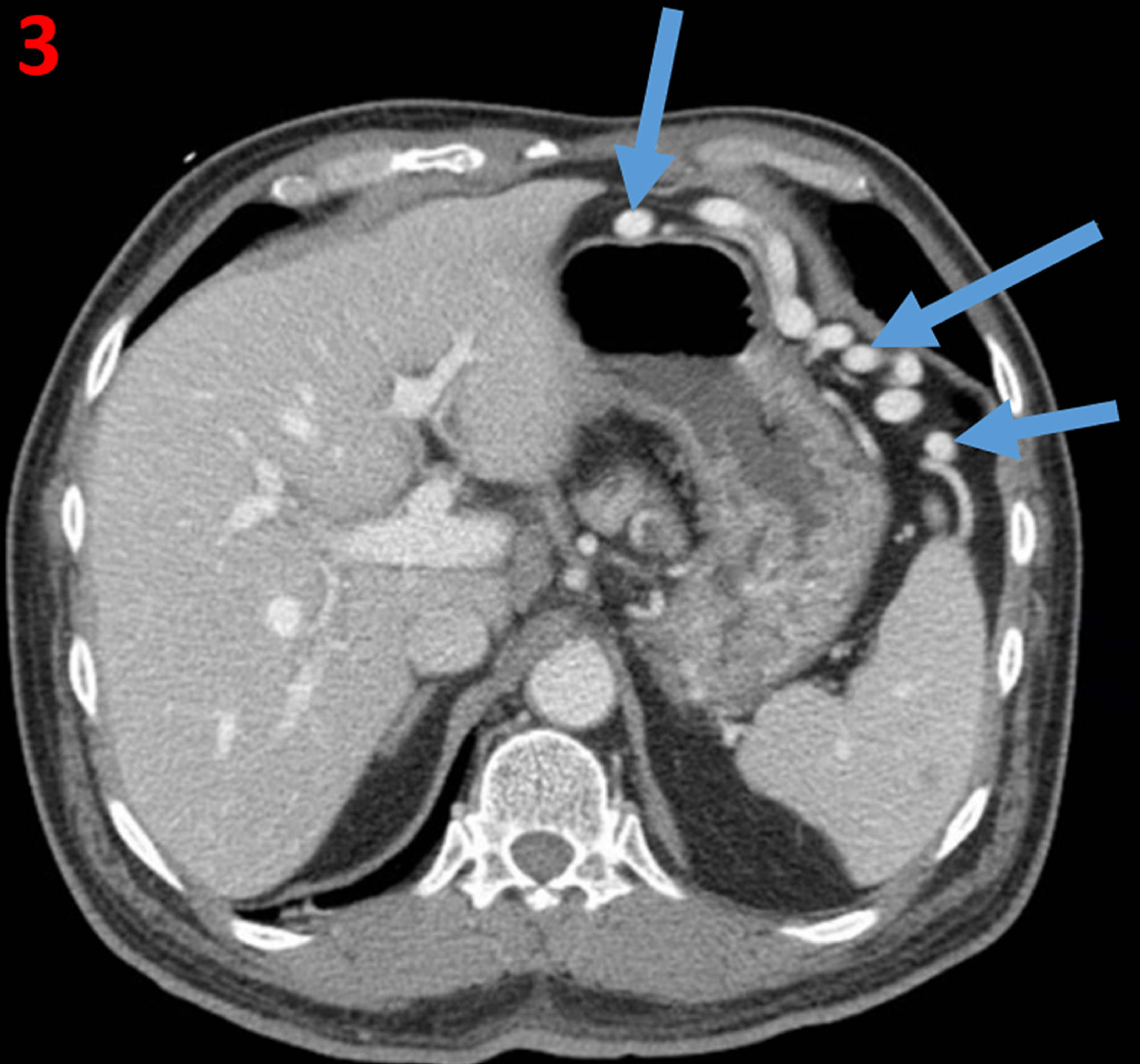 Cureus Vascular Complications Of Splenectomy In A Patient With Gastric Dieulafoy Like Lesions In Left Sided Portal Hypertension Secondary To Splenic Vein And Artery Thrombosis