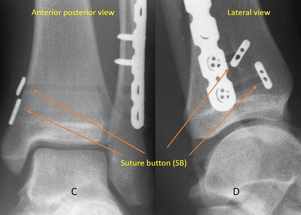 Surgical Outcomes Of Syndesmotic Fixation Of Ankle Fractures Using ...