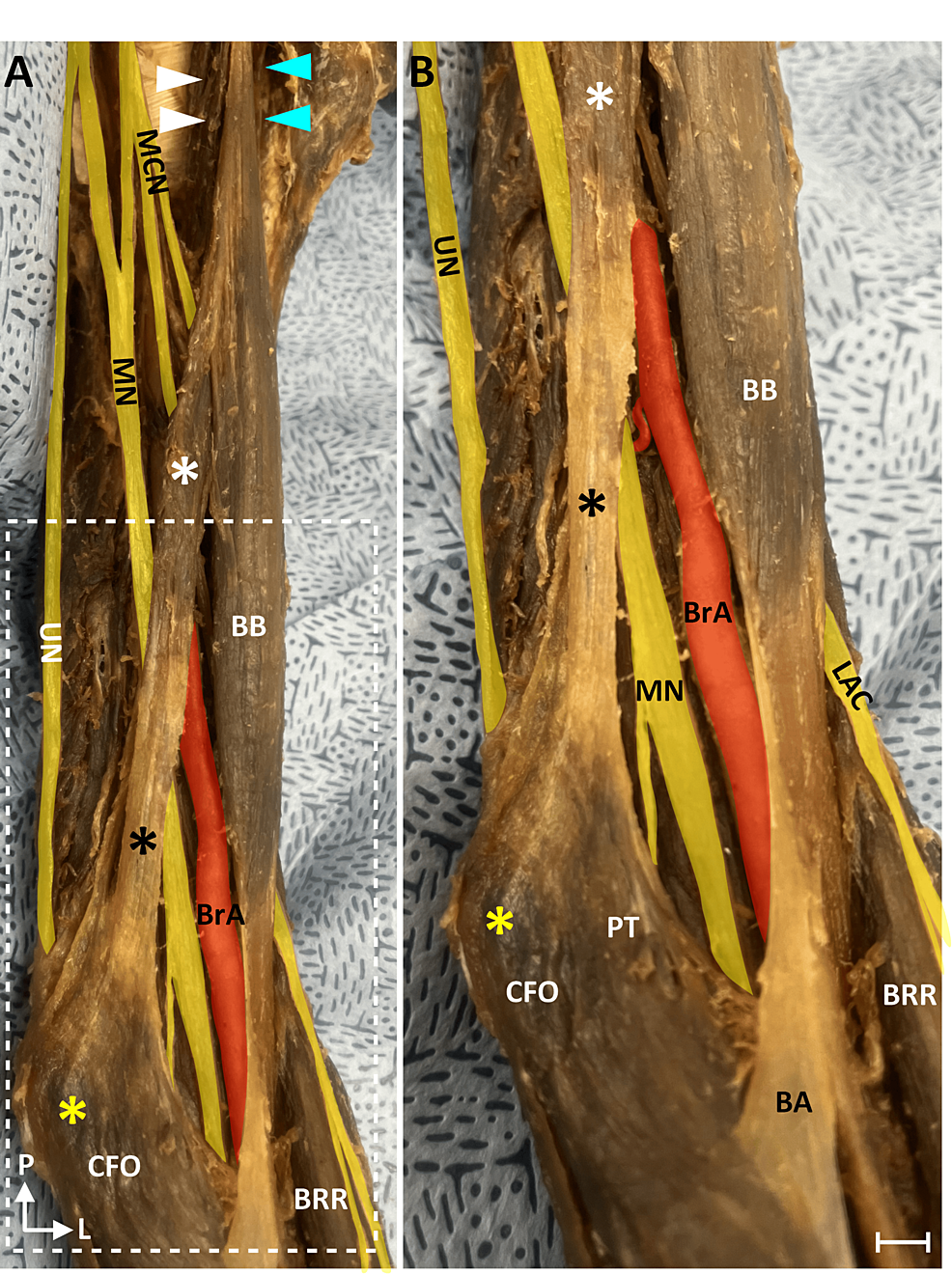 Origin and distribution of the brachial plexus in red‐necked wallaby  (Notamacropus rufogriseus, Marsupialia: Macropodidae) - Bakıcı - 2024 - The  Anatomical Record - Wiley Online Library, image size:986x1320