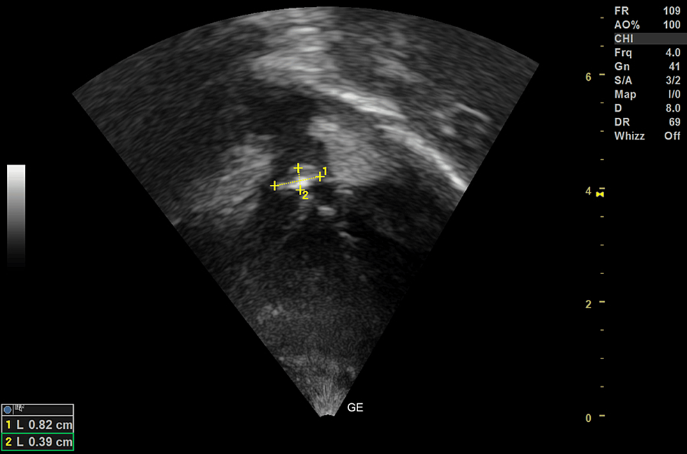 Pulmonary Valve Endocarditis With Tetralogy of Fallot: A Comprehensive ...