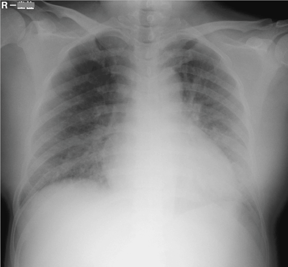 Chest-X-ray-shows-bilateral-opacities-and-butterfly-shadow