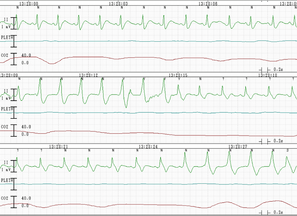 ECG-shows-nonsustained-ventricular-tachycardia