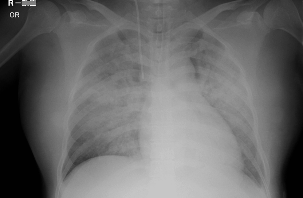 Postoperative-chest-X-ray-shows-massive-pulmonary-edema