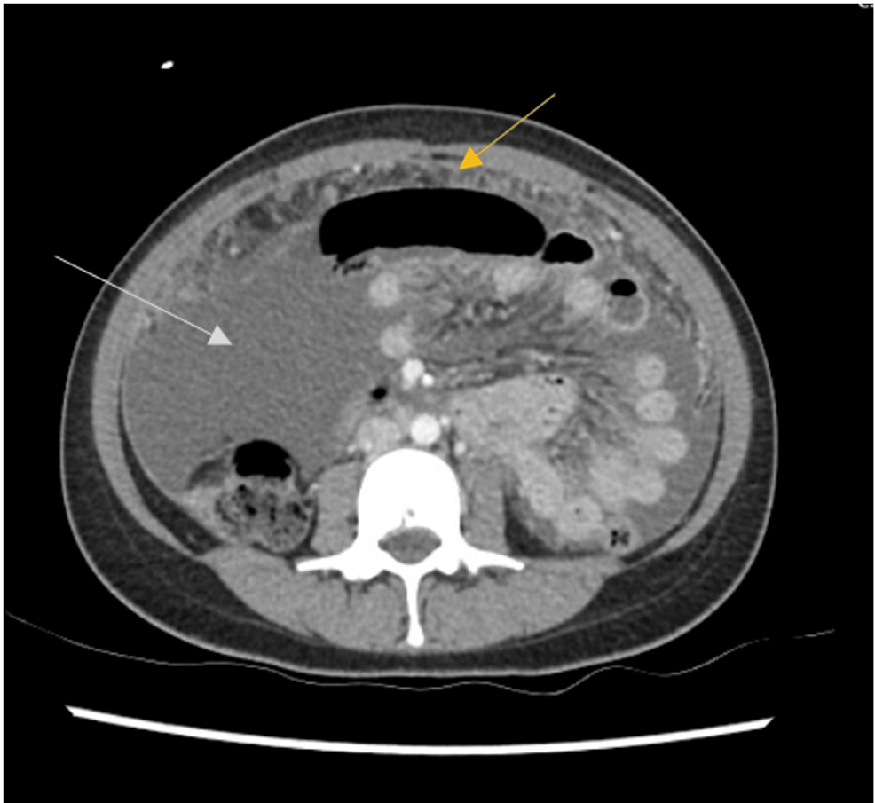 Curative Therapy for a 25 Year‐Old Woman with an Adnexal Mass and Omental  Caking - SHM Abstracts | Society of Hospital Medicine