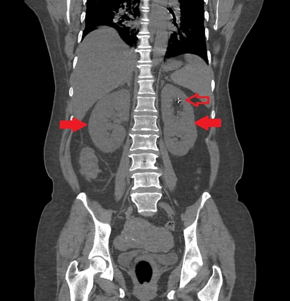 non obstructive left renal calculus