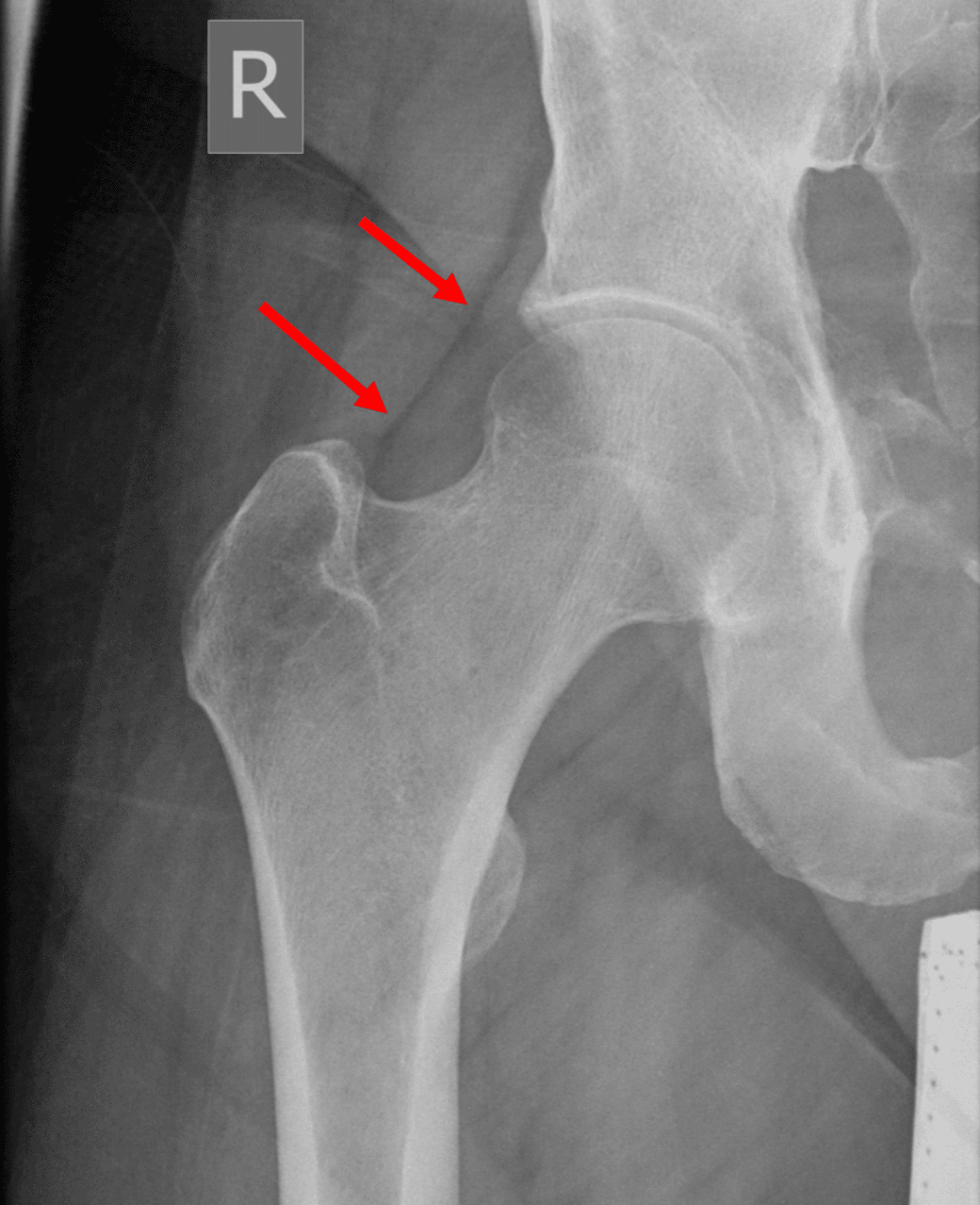 Cureus | Tuberculous Septic Arthritis Of The Hip Following The Incision ...