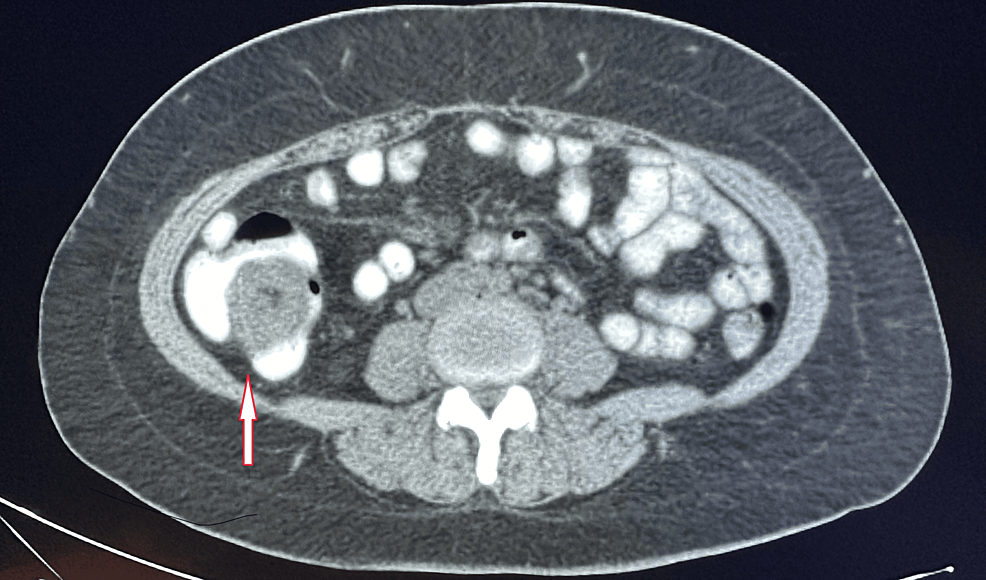 cureus-endoscopic-retrograde-appendicitis-therapy-in-subacute