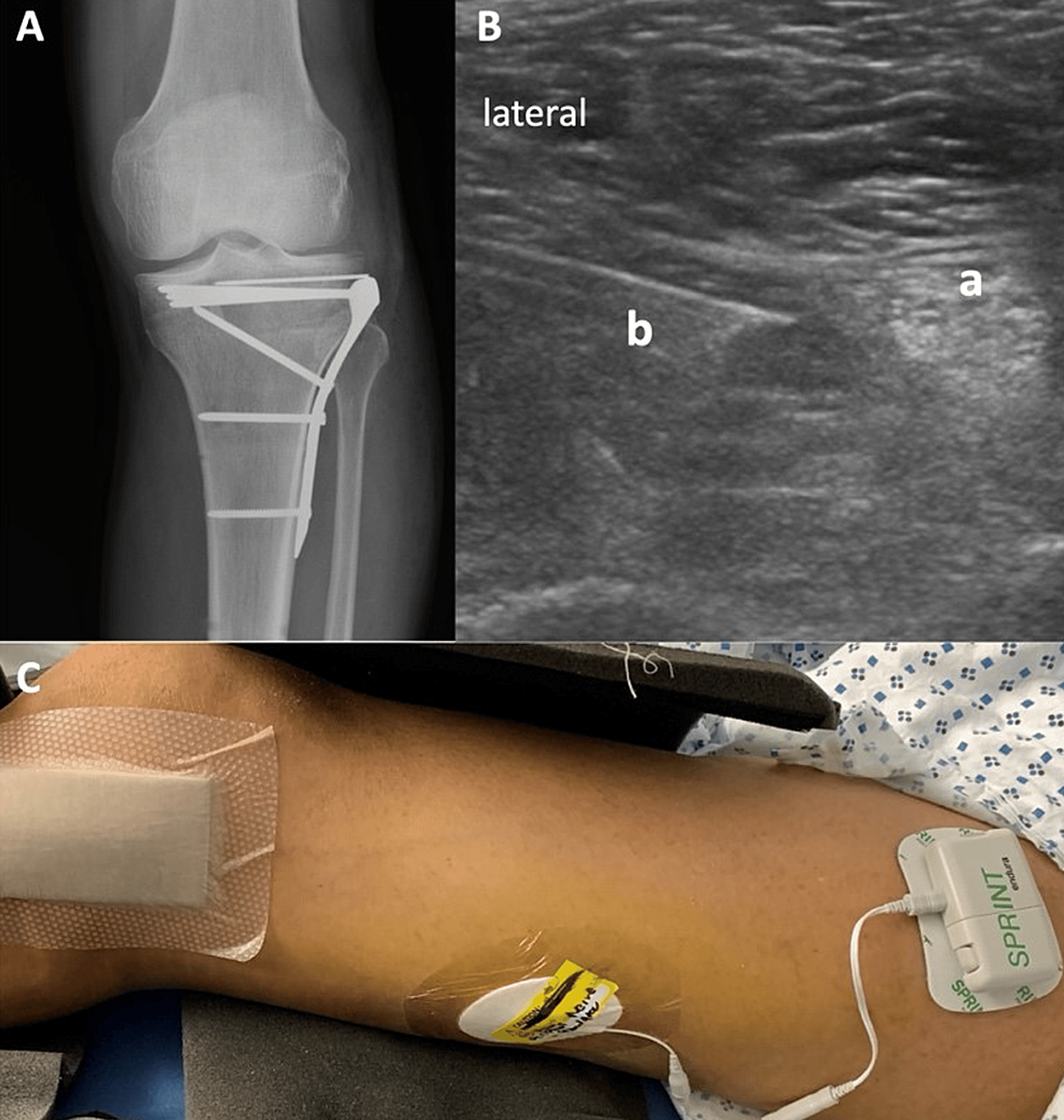 Images-of-peripheral-nerve-stimulation-(PNS)-placement-