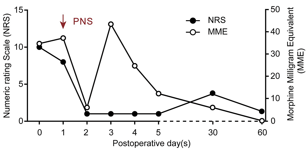 Post-PNS-placement-pain-score-and-opioid-usage