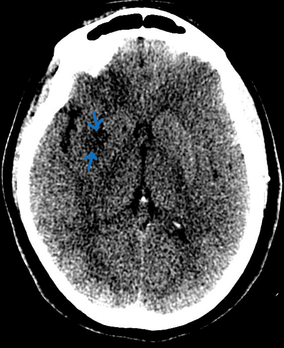 An Atypical Case of Polycystic Ovarian Syndrome and Possible Newly ...