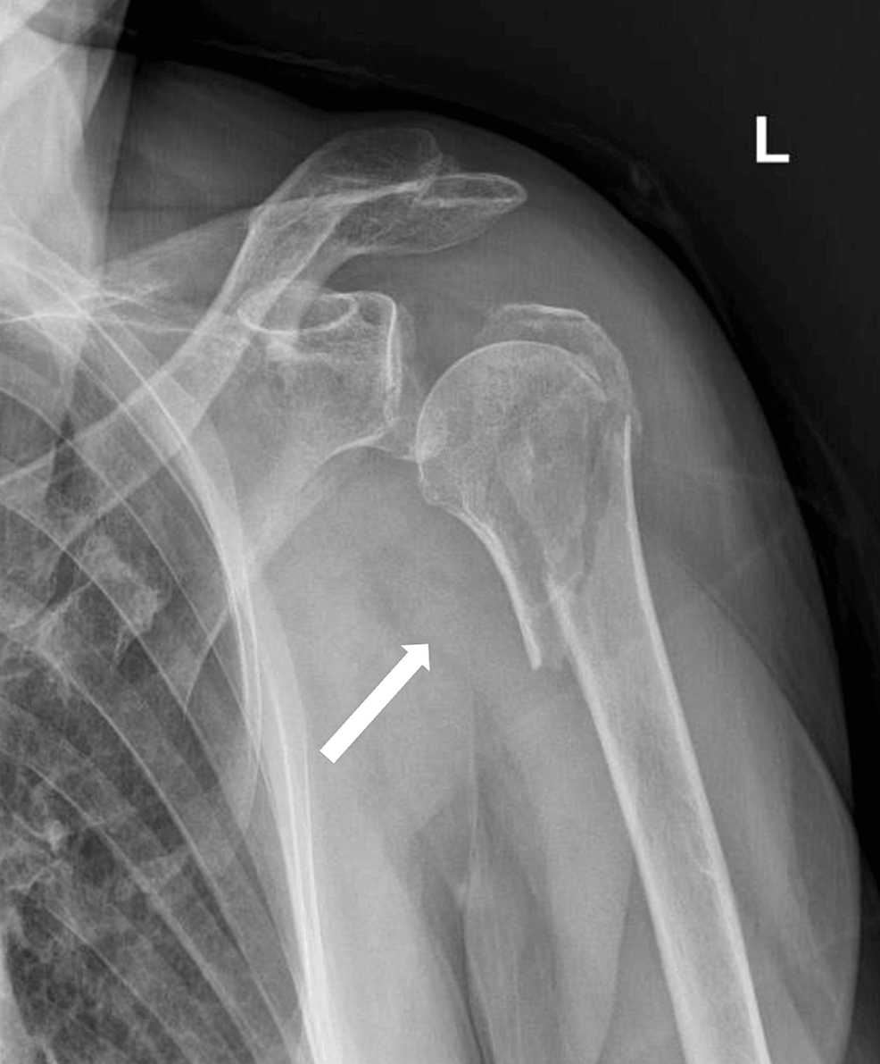 Cureus, Reverse Shoulder Megaprosthesis for Massive Proximal Humeral Bone  Loss in Fracture Outcome Settings: A Report of Two Cases and Literature  Review