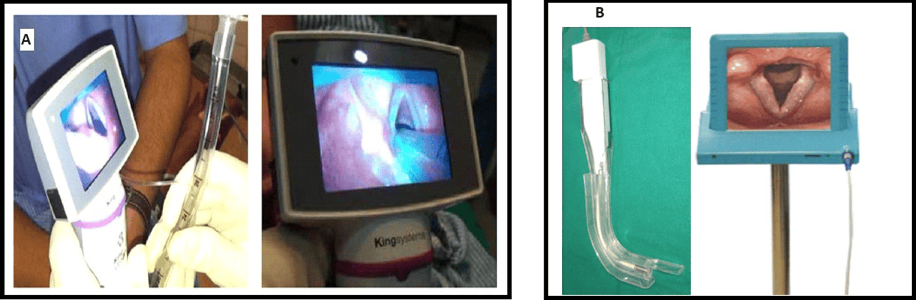 Comparative Evaluation of Linscope and King Vision Video Laryngoscopes in Tracheal Intubation A