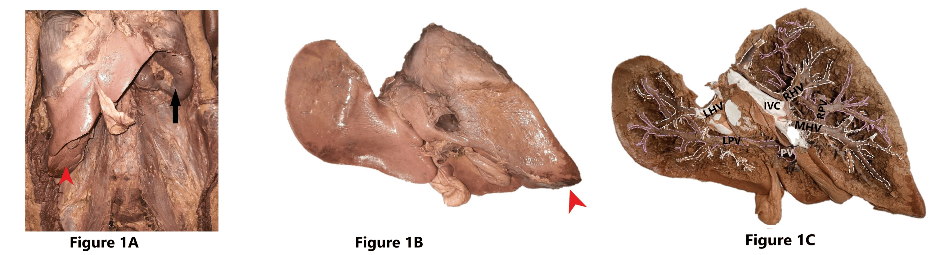 Cureus Riedel’s Lobe and Beaver Tail Variant A Cadaveric Case Report