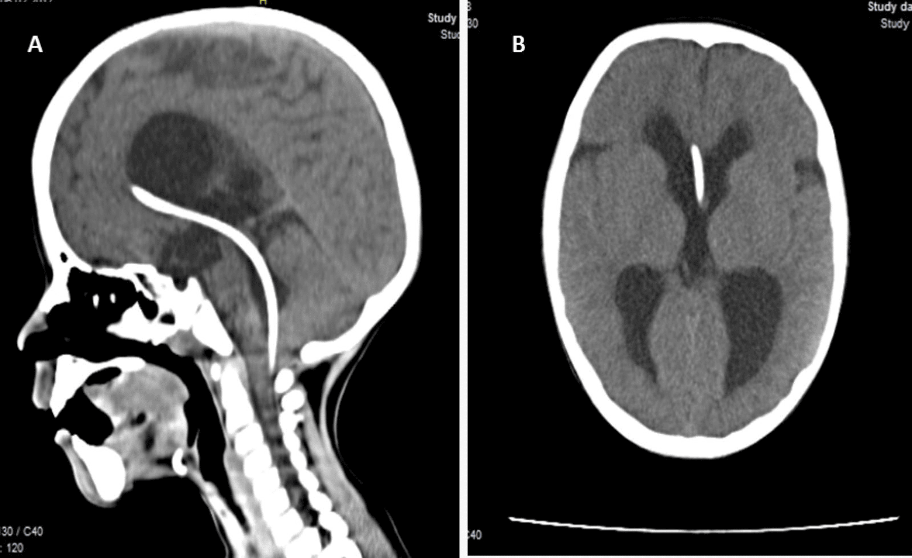 Cureus Endoscopic Ventriculocysternostomy Magendie Foraminoplasty cureus-endoscopic-ventriculocysternostomy-magendie-foraminoplasty