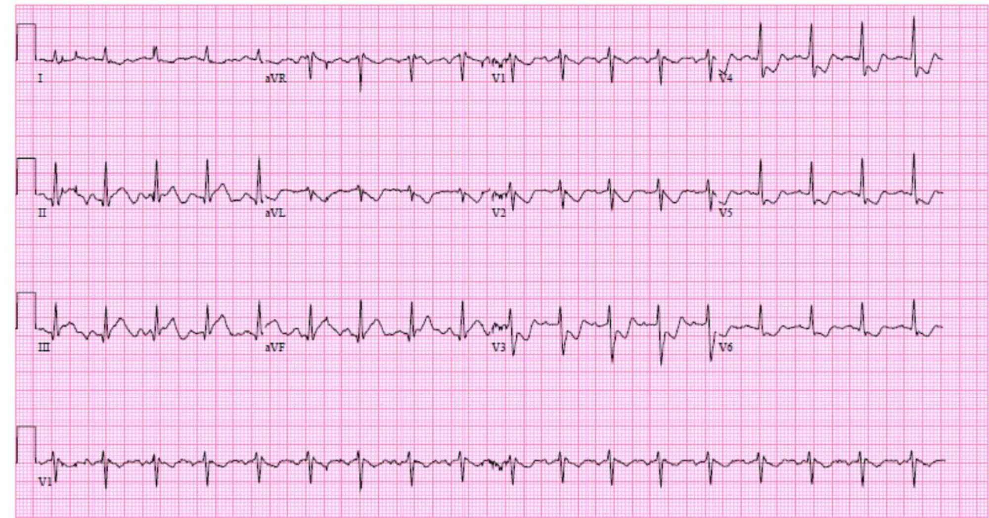 RCA STEMI EKG