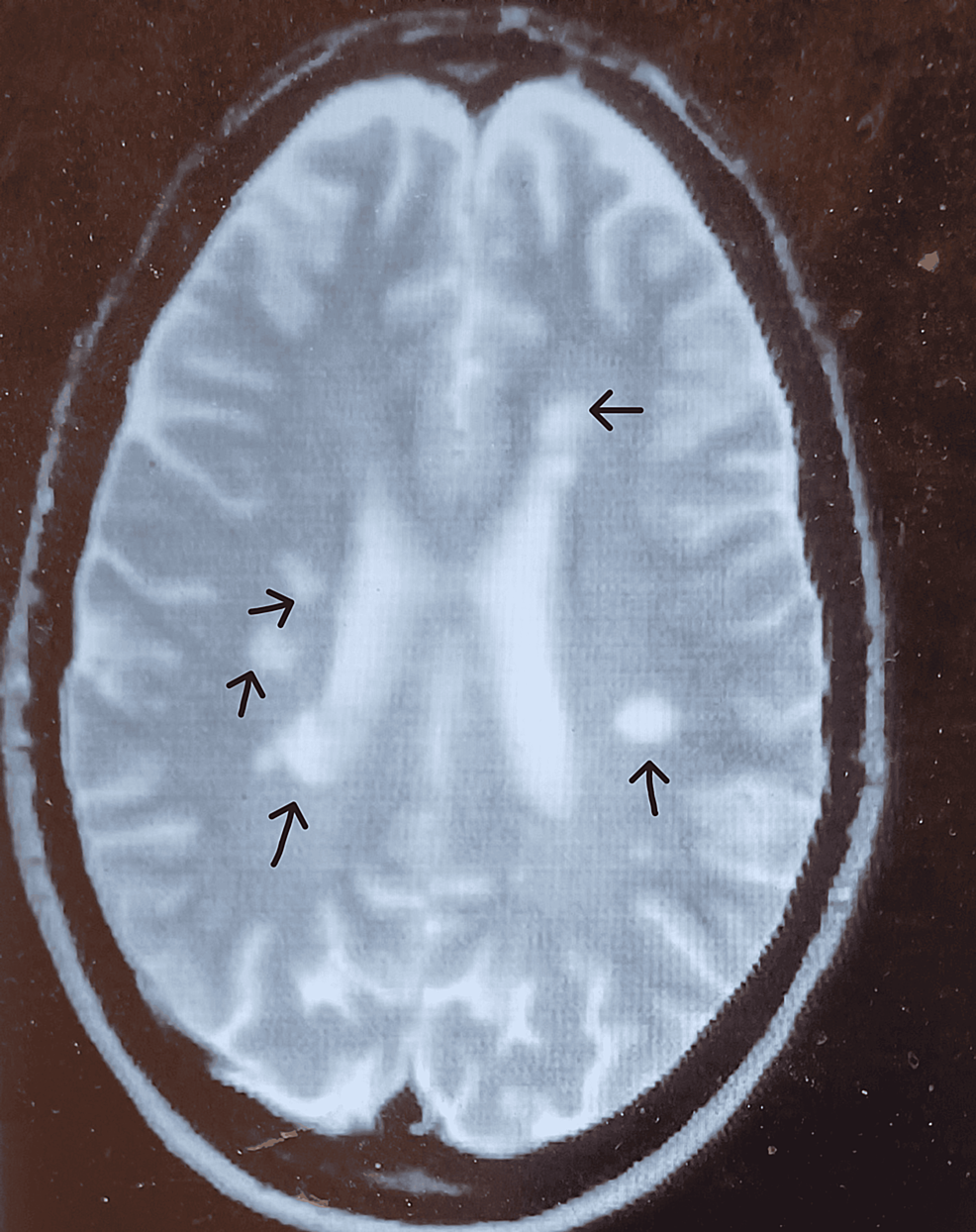 capgras-syndrome-multiple-sclerosis-and-covid-19-infection-a-case
