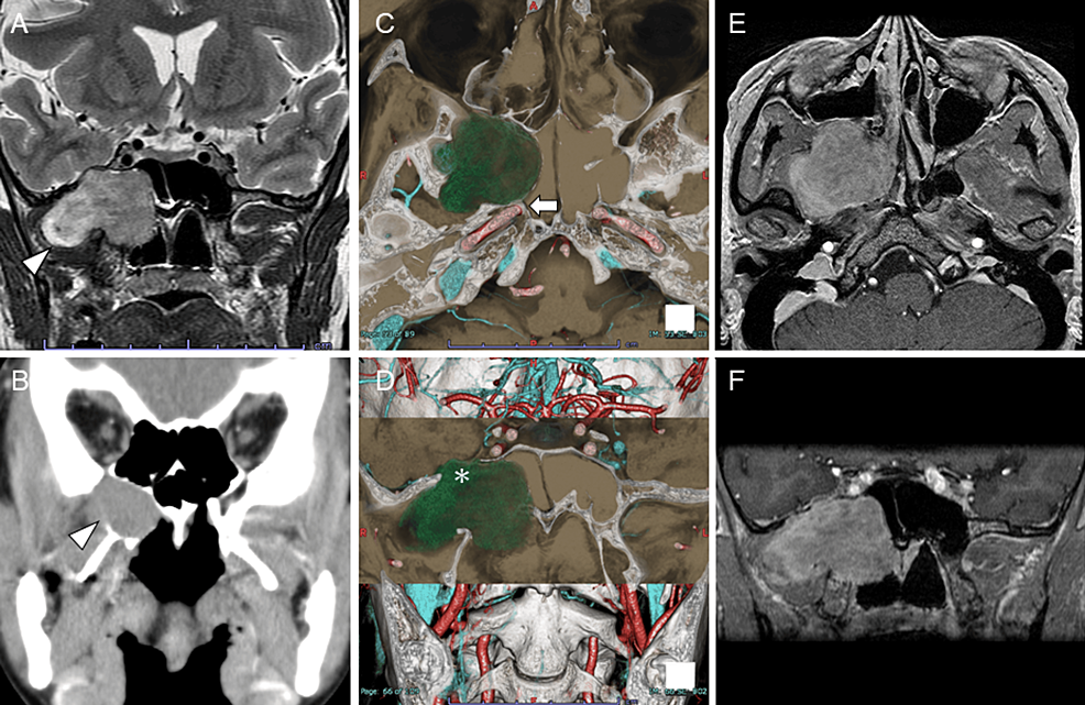 Extracapsular Dissection With Narrow Band Imaging Using The Transnasal