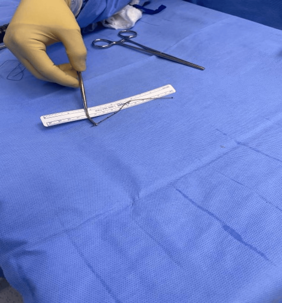Broken Epidural Catheter After Vaginal Delivery Cureus