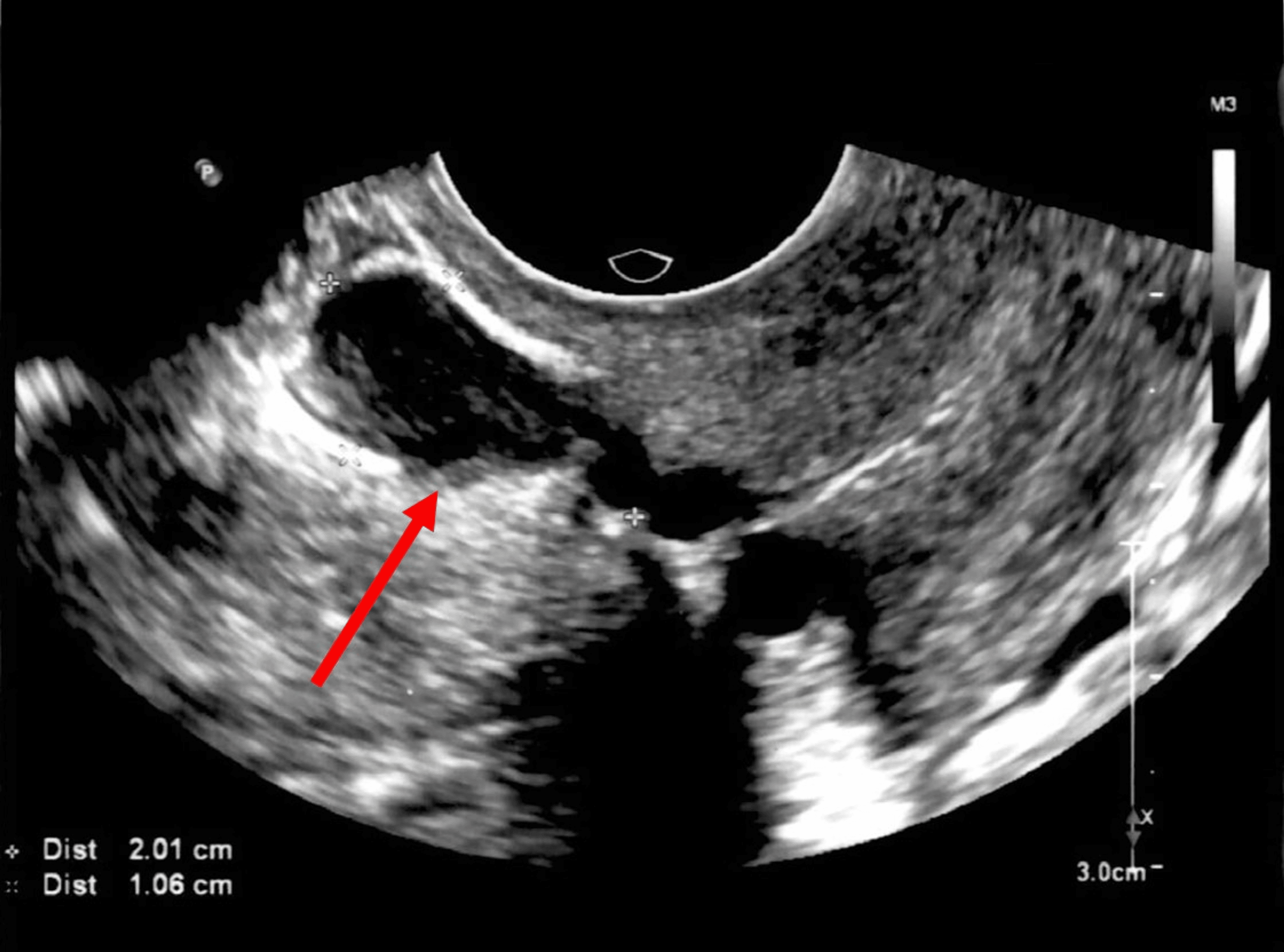 Cureus Laparoscopic Correction of Isthmocele and Cesarean Scar