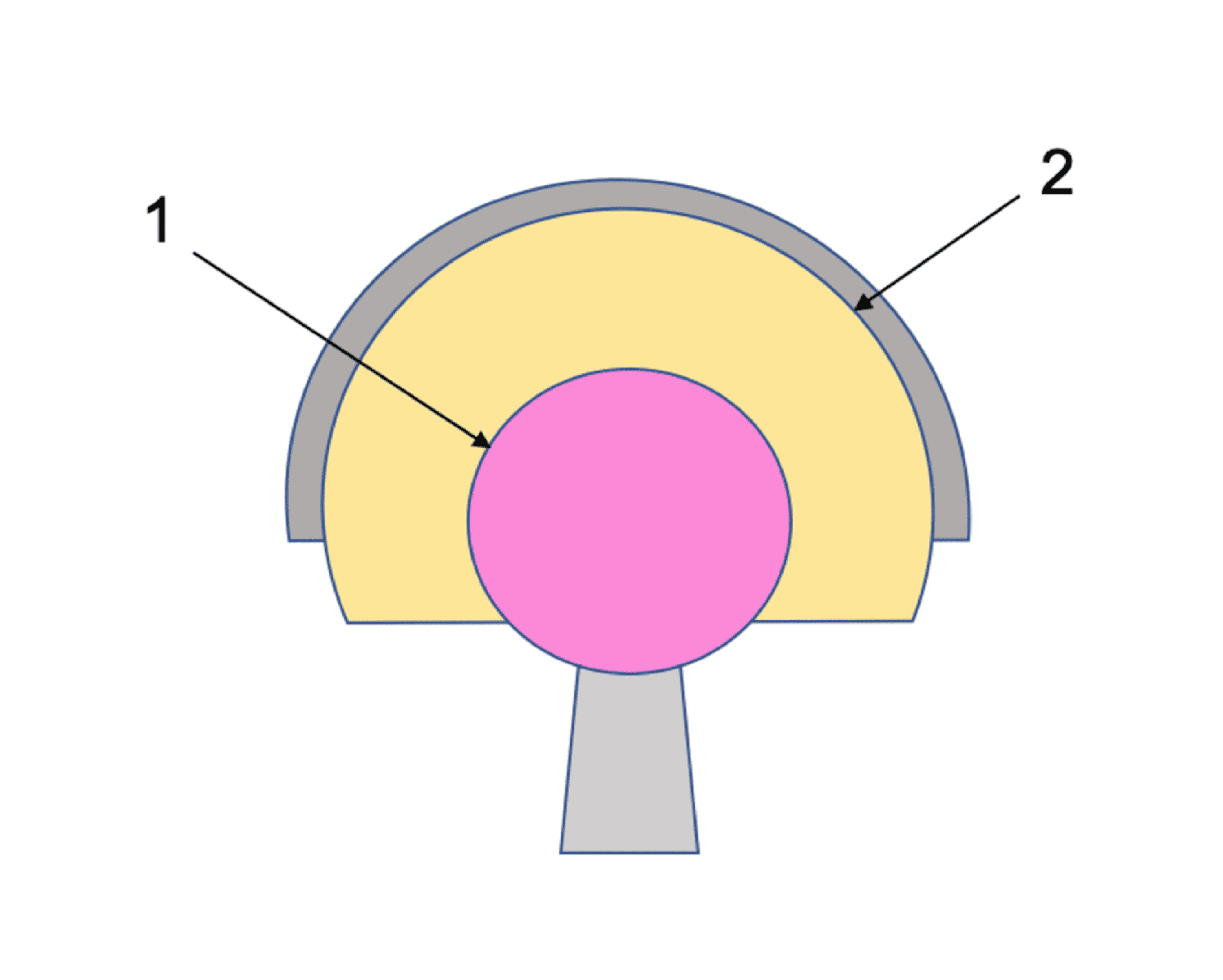 Cureus of Dual Mobility Bearings in Revision Total Hip