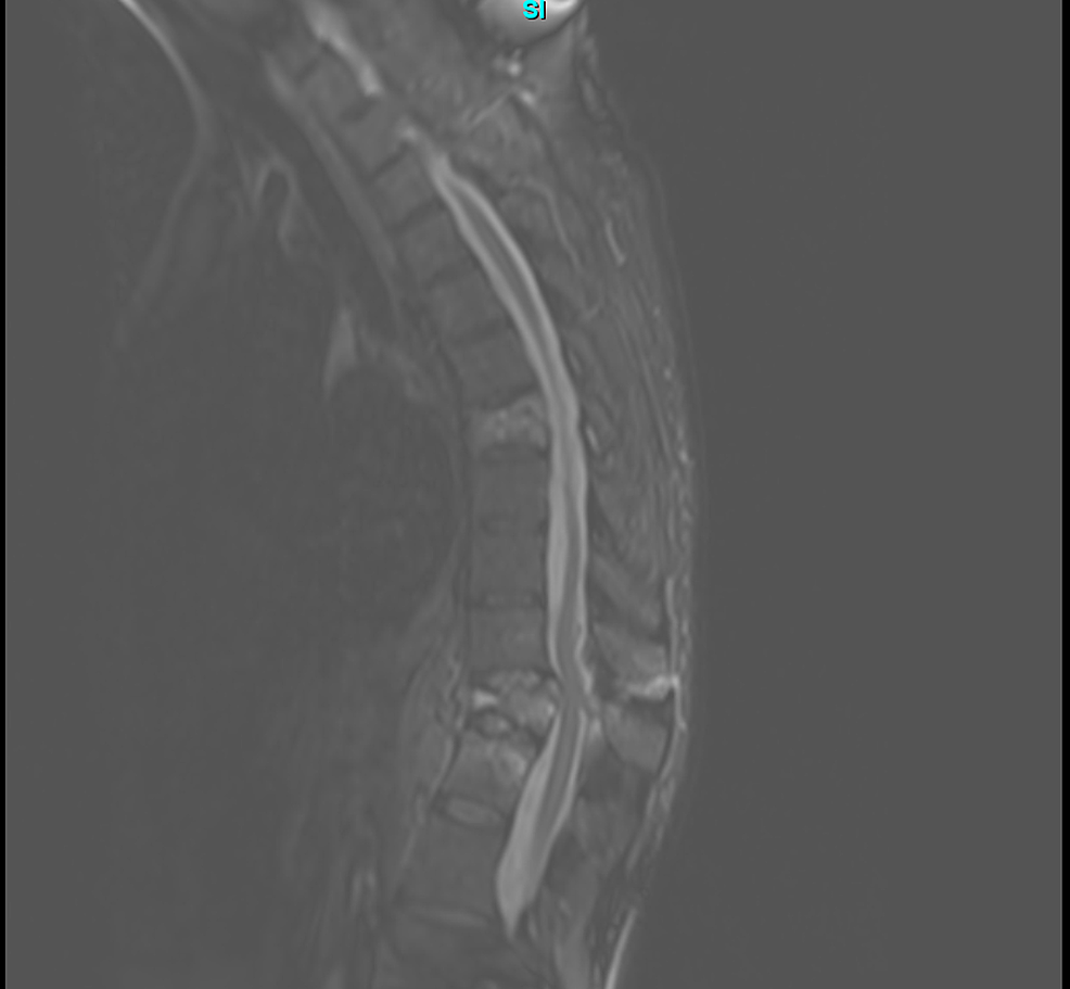 Rare Systemic Response to Titanium Spinal Fusion Implant Case Report