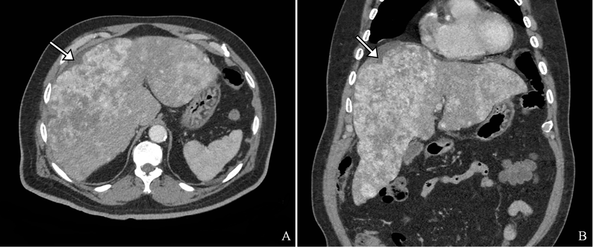 Cureus | Hepatic Angiosarcoma: A Case Presentation