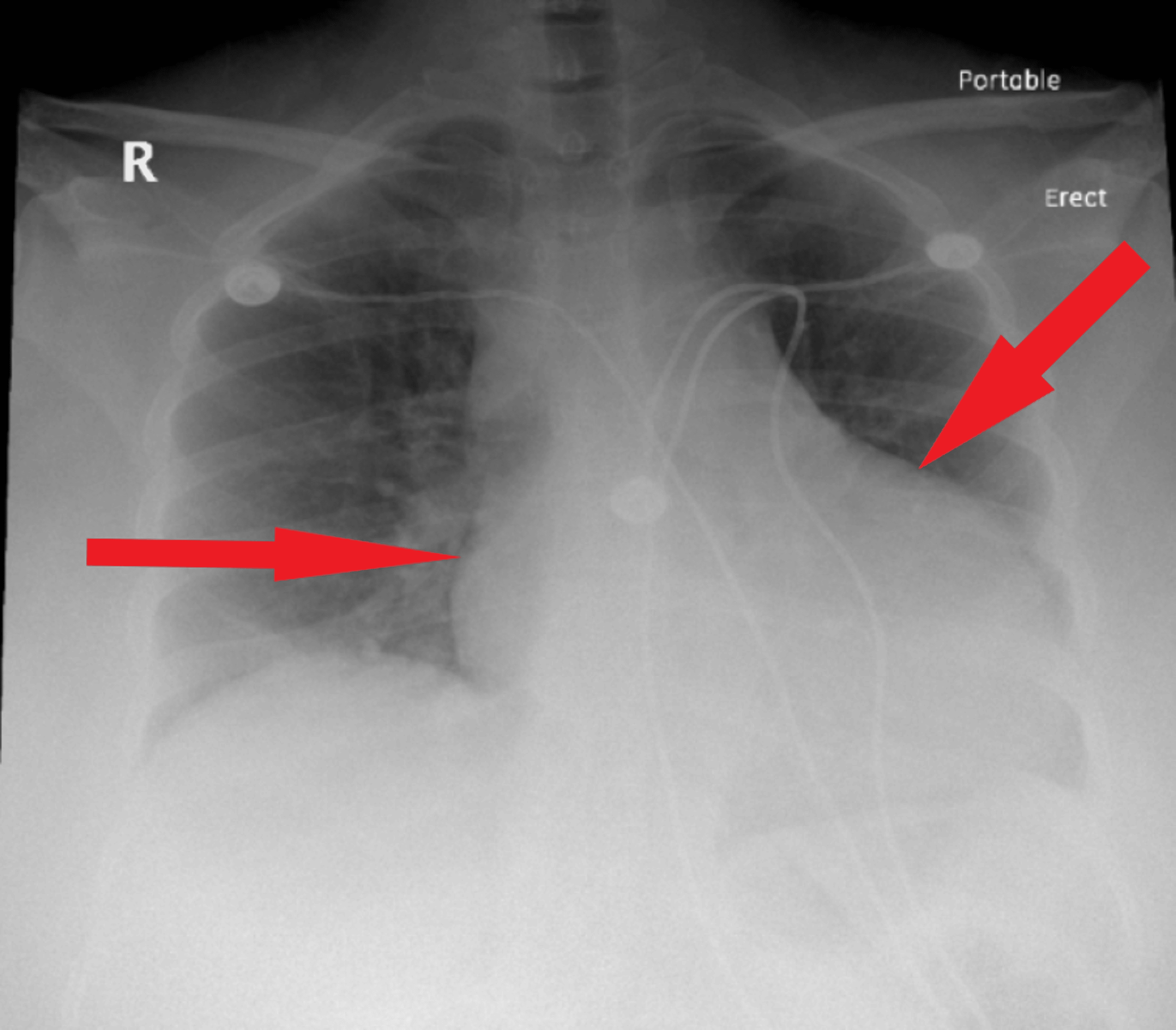 Surviving the Storm: Cardiac Tamponade and Effusive Constrictive ...