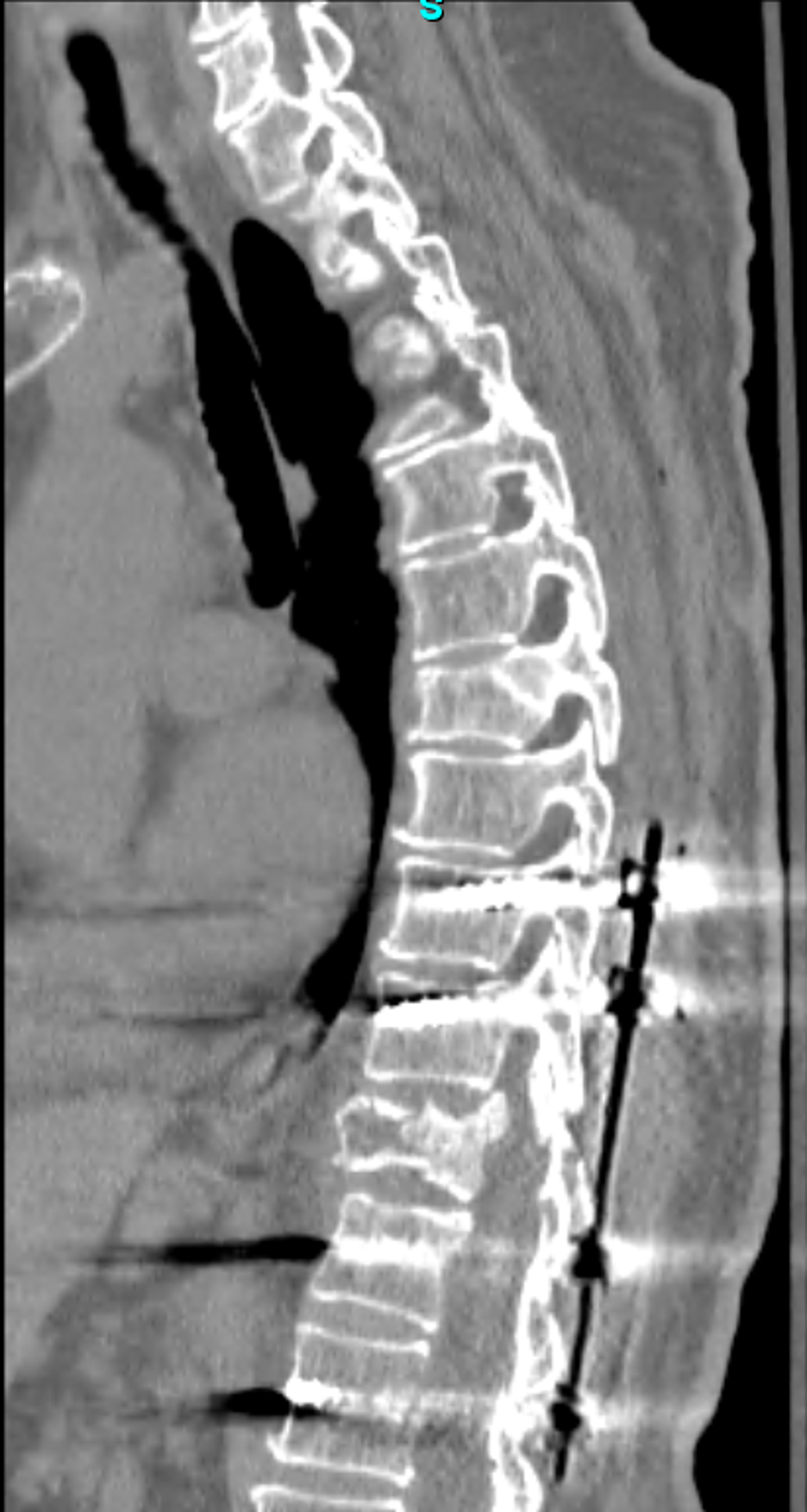 Post-operative-computed-tomography-demonstrating-T9-L1-pedicle-screw-fixation