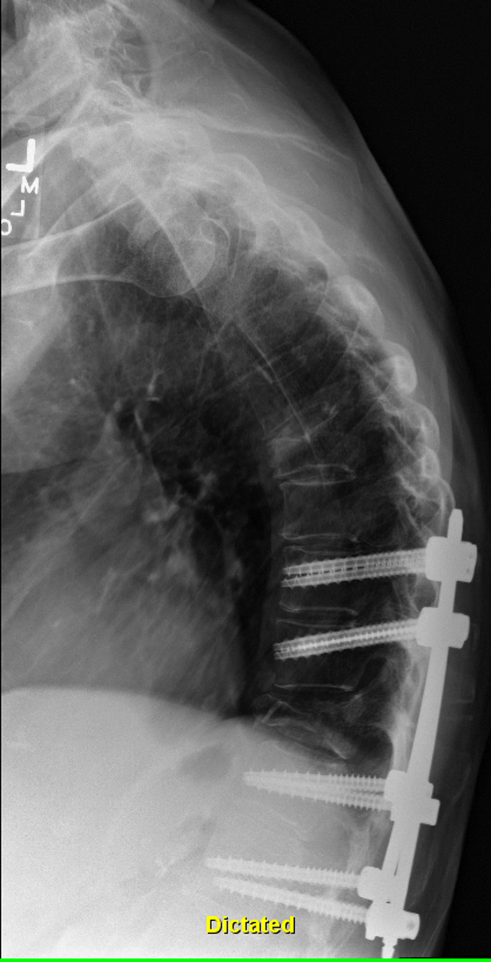 Three-months-post-operative-thoracic-spine-X-ray-with-intact-hardware-without-lucency