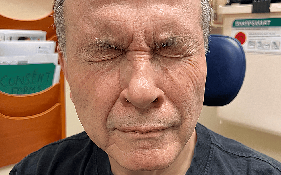 Cureus Acute Onset of Delayed Facial Nerve Paralysis After an