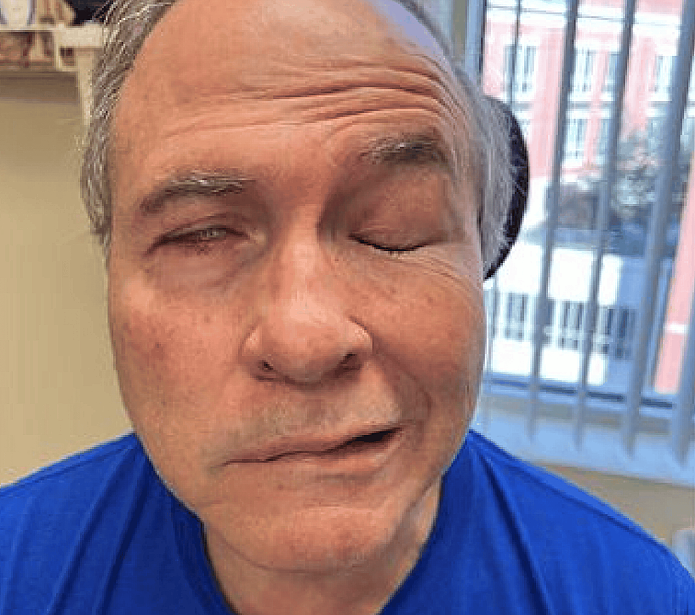 Cureus Acute Onset of Delayed Facial Nerve Paralysis After an