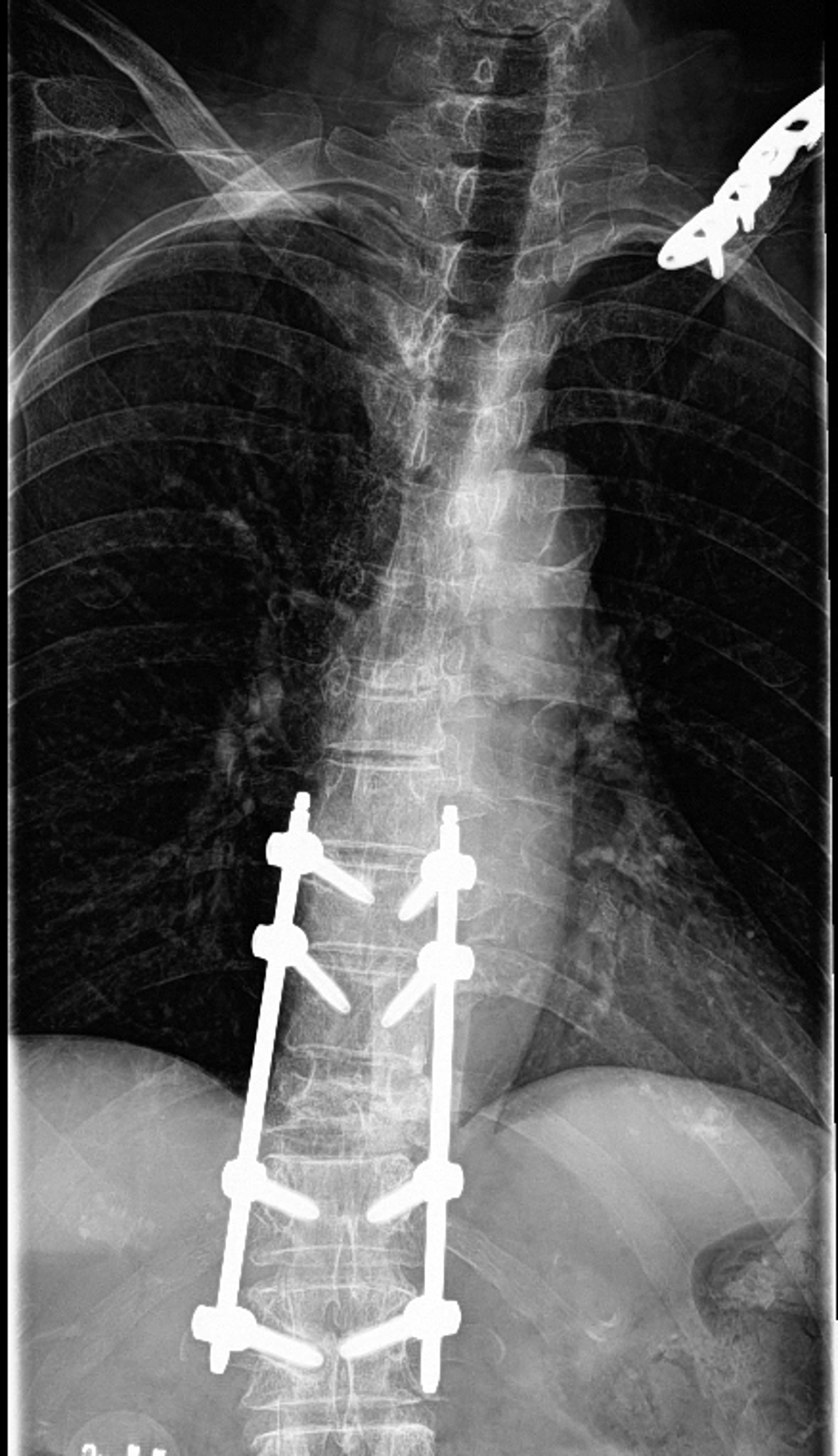 Six-months-post-operative-thoracic-spine-X-ray-with-intact-hardware-without-lucency,-left-clavicular-plate