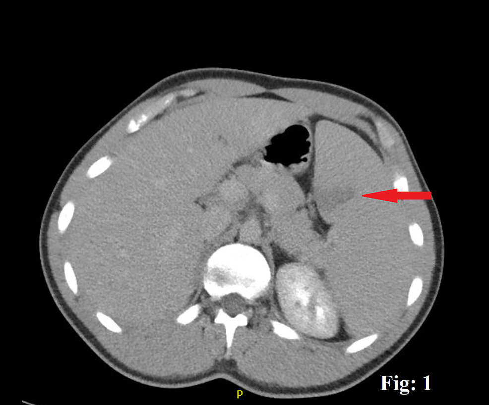 Cureus A Mysterious Case of an Infarcted Spleen due to Kissing