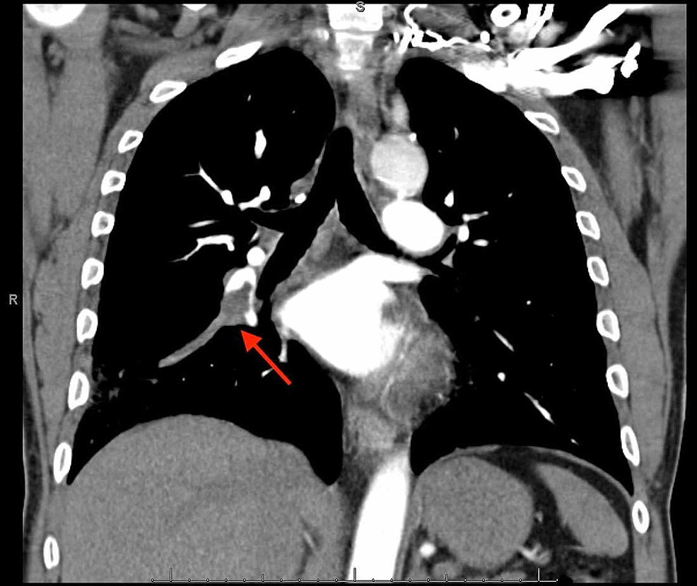 cureus-cocaine-a-provoking-risk-factor-in-venous-thromboembolism