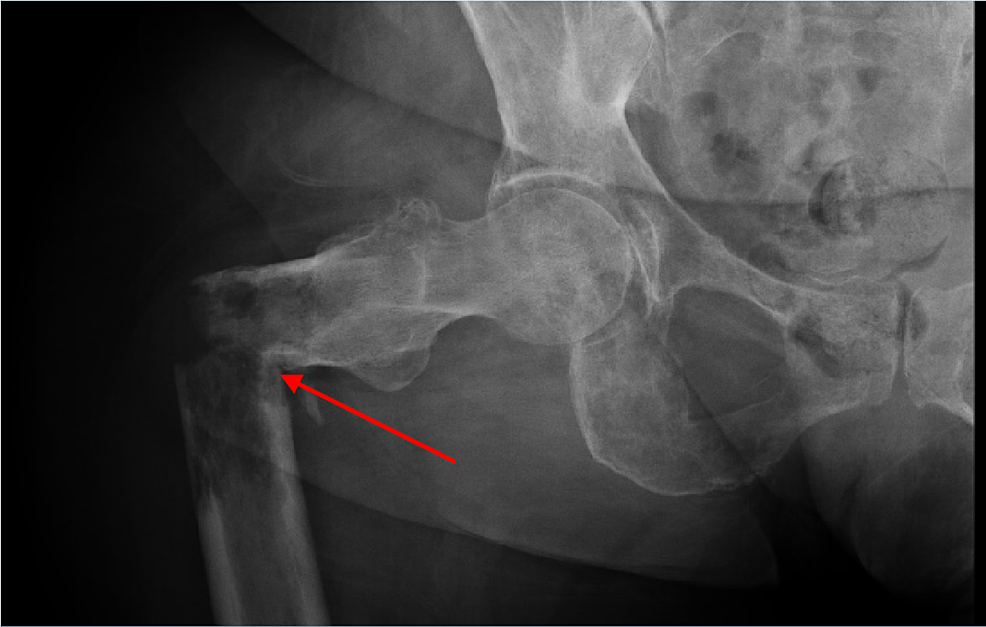 pathologic fracture x ray