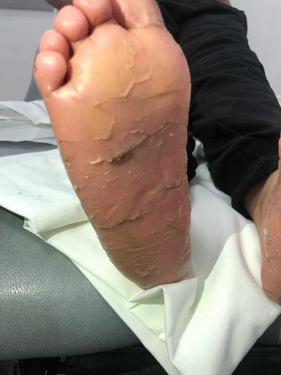 Erythematous-hyperkeratotic-skin-plaques-and-papules-with-scales-over-the-soles-of-both-feet.