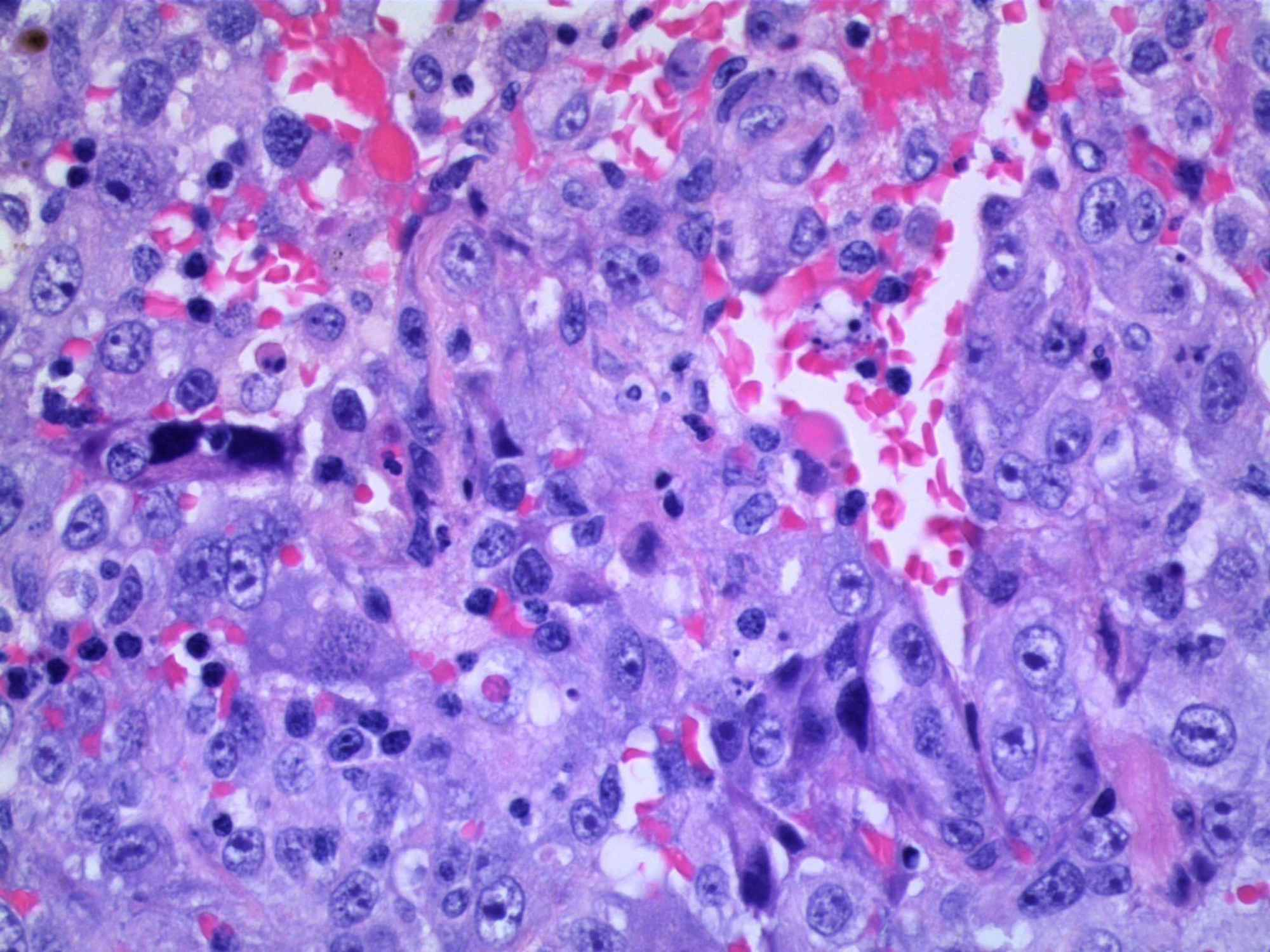 Cureus | Primary Pulmonary Epithelioid Angiosarcoma: A Rare Case ...