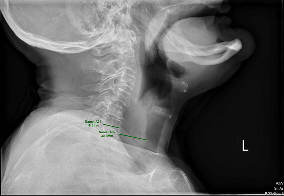 Cureus A Diagnostic Dilemma of Prevertebral Abscess Versus Food Bolus