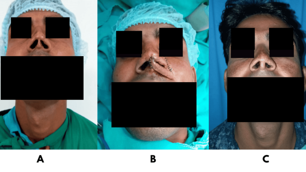 Evaluation of Nasal Reconstruction With Local Flaps Using the