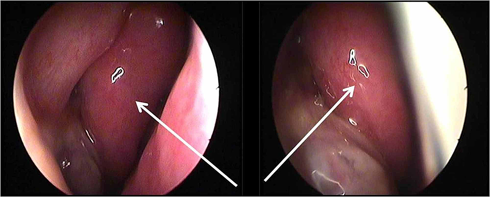 nasal obstruction