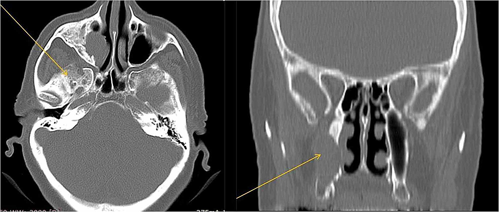 Cureus | Ameloblastoma on the Maxillary Sinus: Cause of Unilateral ...