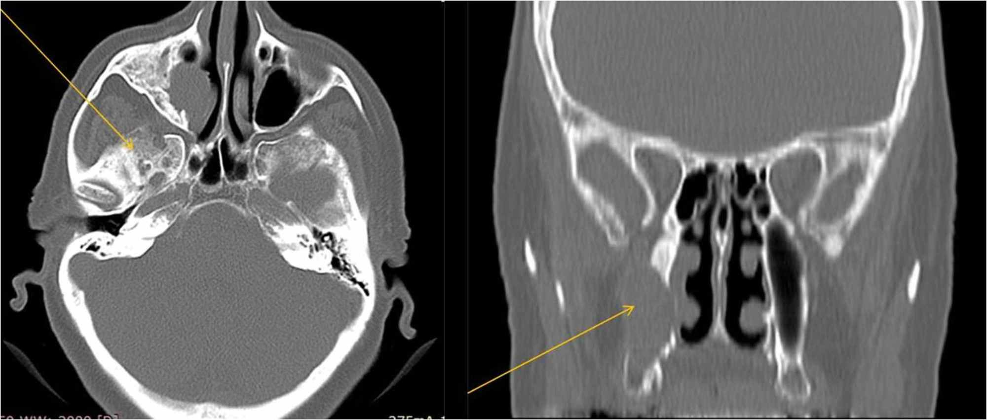 The Maxillary Sinus Sage Journals