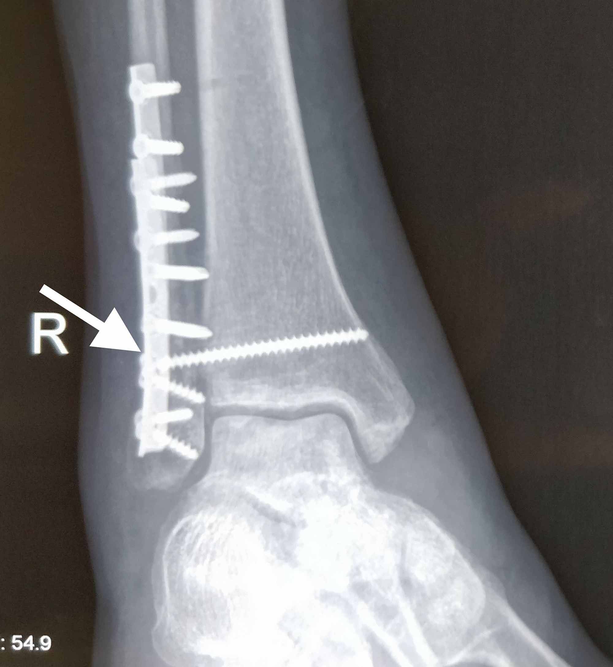 proximal and distal fibula fracture