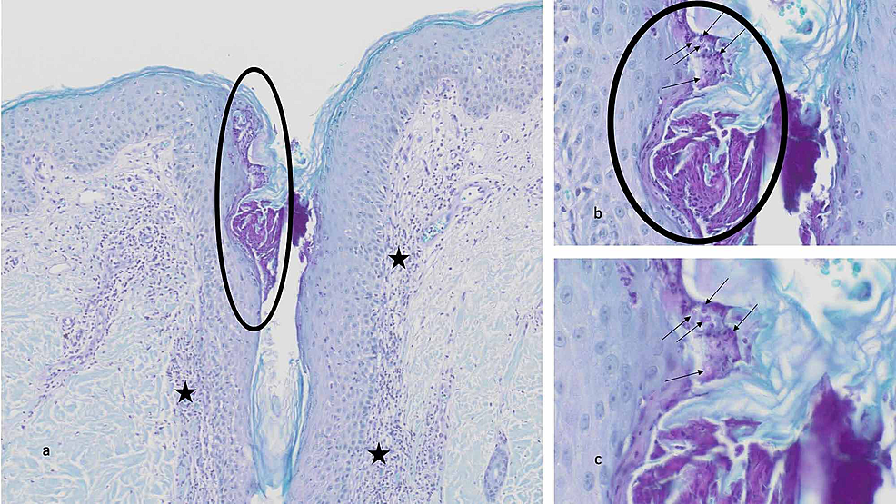 Pathologic-changes-of-Malassezia-folliculitis—periodic-acid-Schiff-stained-sections