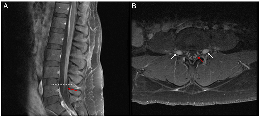 Lumbar-spine-magnetic-resonance-imaging-(MRI)-of-a-41-year-old-female-with-postpartum-Guillain-Barré-syndrome.