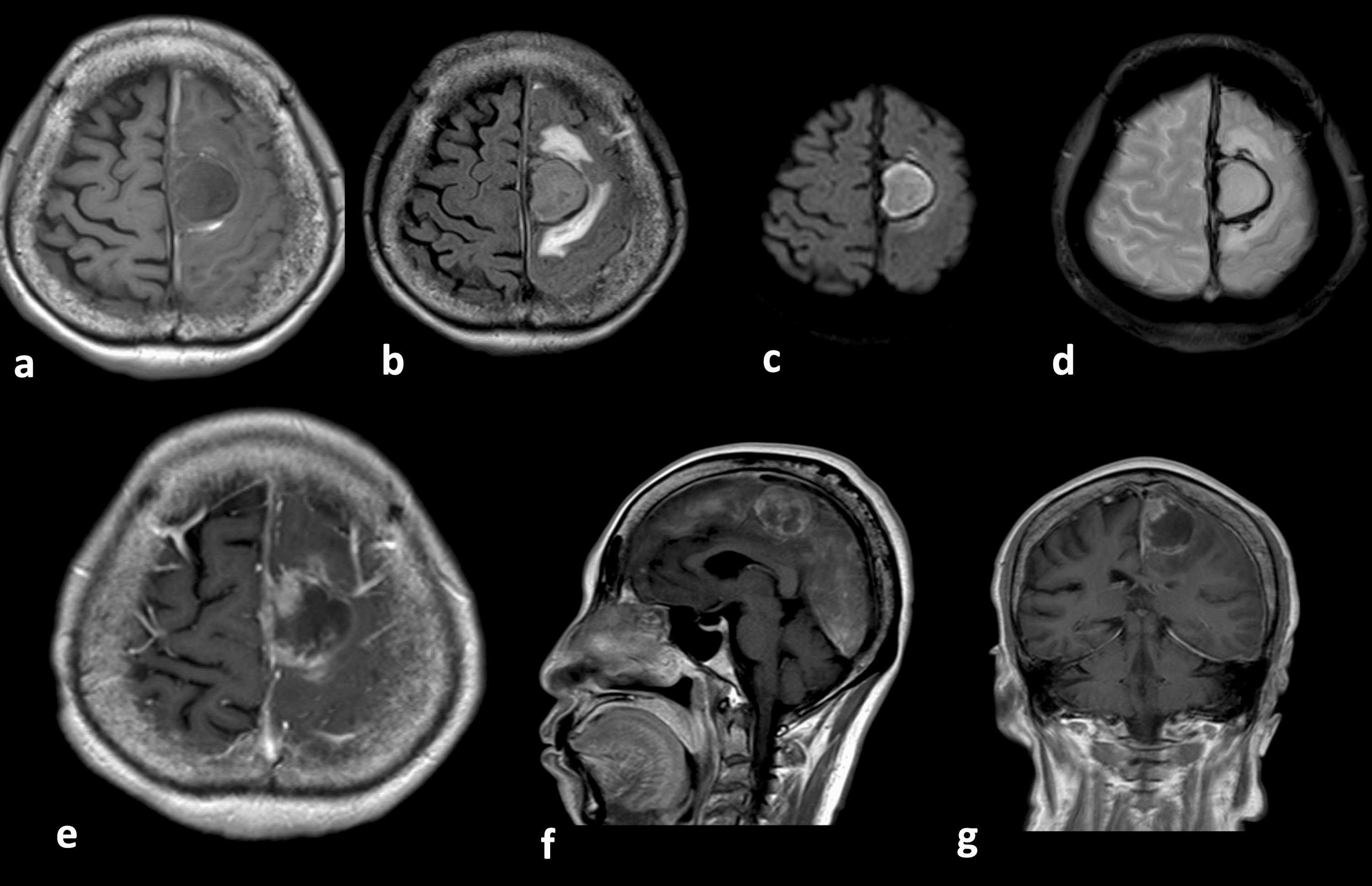 Cureus Interhemispheric Acute Subdural Hematoma Secondary To Falx Meningioma A Case Report 7015